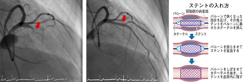 ステントの入れ方